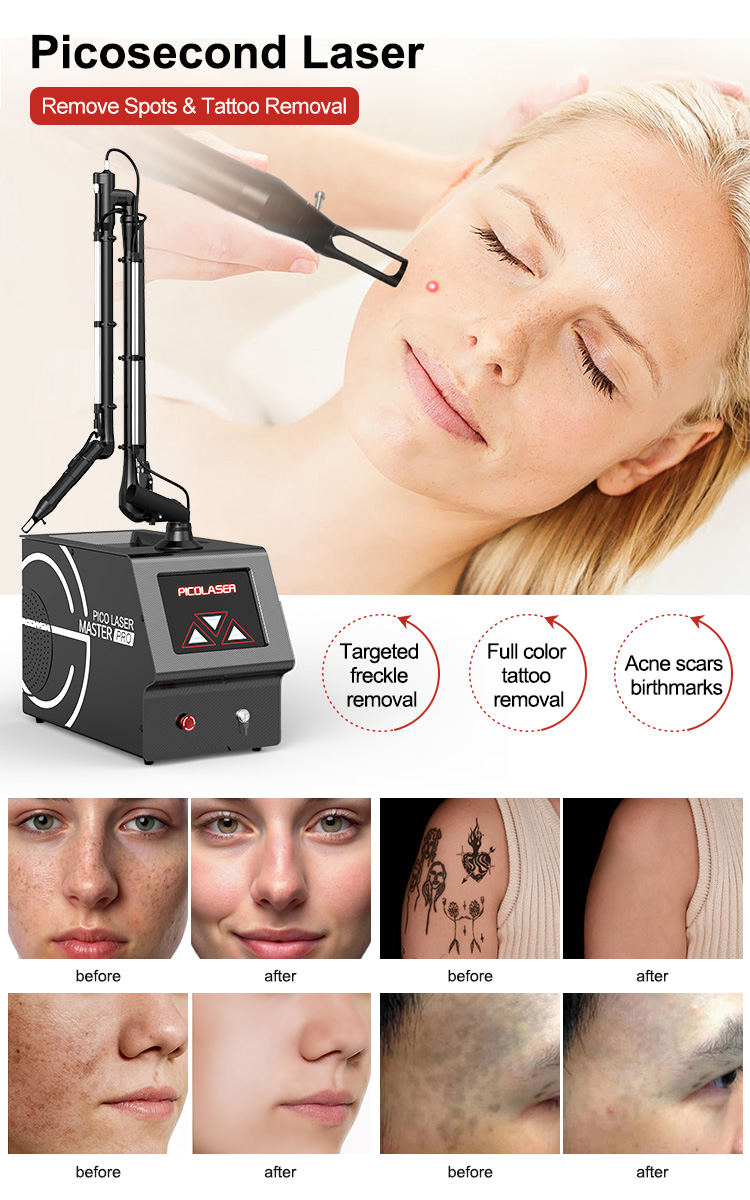 Non invasive Laser Skin Care10